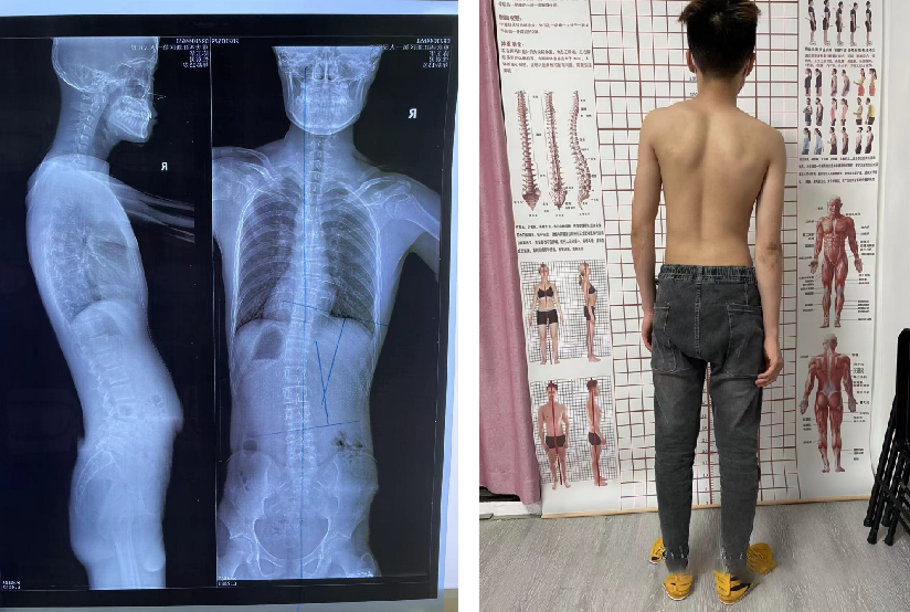 青少年脊柱侧弯 昭通李景铧医院有“神器”-昭通李景铧中医骨伤医院