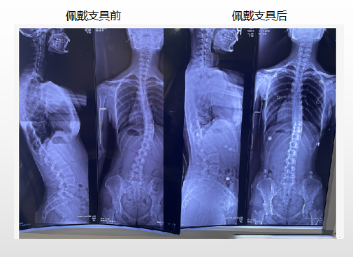 青少年脊柱侧弯 昭通李景铧医院有“神器”-昭通李景铧中医骨伤医院